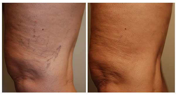 Sclerotherapy  Best Treatment For Spider Veins