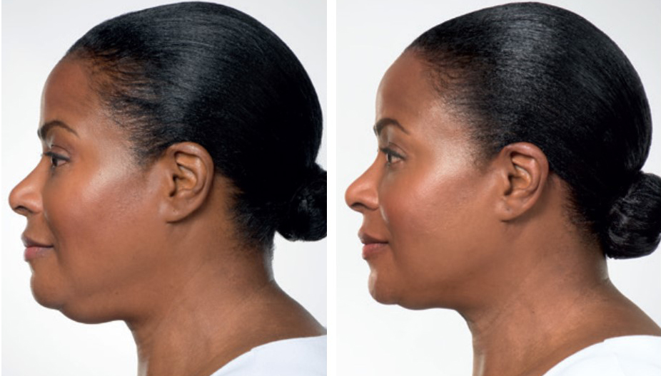 Kybella® Double Chin Treatment - Rejuvenation Clinic