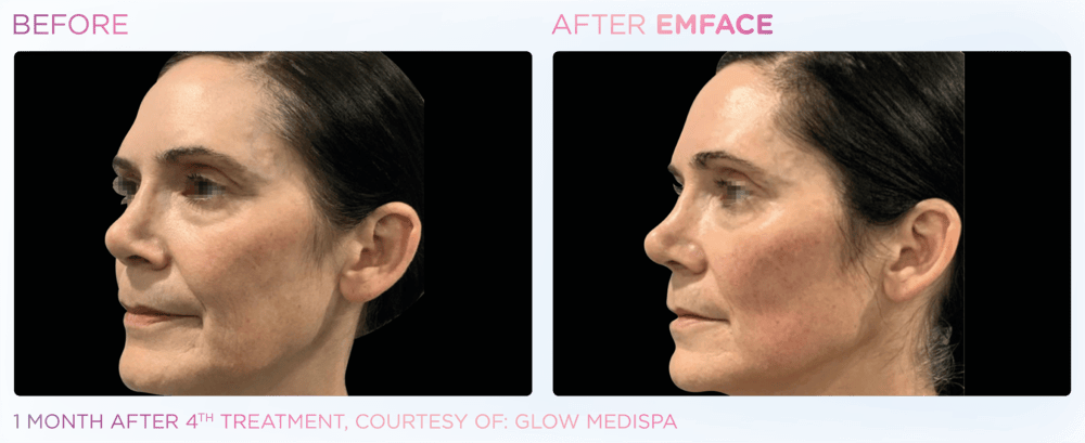 emface treatment before and after